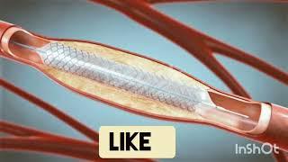 Stent implantation in blood vessels! Angioplasty! 3d animation!cornory Angioplasty! medical world!