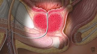 Mayo Clinic Minute - Lifestyle changes enlarged prostate