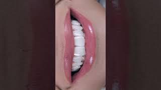 #cosmeticdentistry #smiledesigner #compositeveneers #dentalstudents #estheticdentistry #dentalart