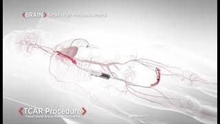 TCAR - Transcarotid Artery Revascularization