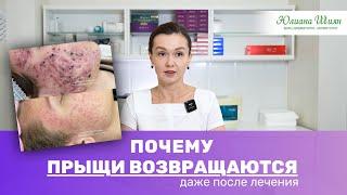 Как вылечить акне и розацеа навсегда. Это важно знать каждому человеку с проблемной кожей.