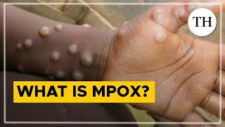 What is mpox? | The Hindu