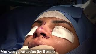 Alar Wedge Resection-49/987:Rhinoplasty Bizrah- London/ Dubai-Dr Bashar Bizrah