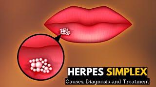 Herpes Simplex, Causes, Signs and Symptoms, Diagnosis and Treatment.