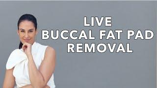 Buccal Fat Removal Surgery + Before and After Photos | Nazarian Plastic Surgery