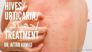 Hives / Urticaria treatment in Homeopathy | چھپاکی کا علاج | Aftab Ahmad Homeo Tips