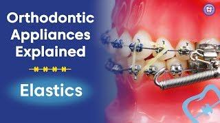 Orthodontic Appliances Explained | Elastics