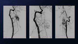 In Situ Occlusion of a Cervical Intramedullary Spinal Cord Arteriovenous Malformation