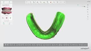 3DBioCAD - 3Shape Implant Studio - 무치아 케이스: 스캔 정렬 및 치은 설정법