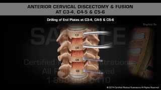 Anterior Cervical Discectomy & Fusion at C3-4, C4-5 & C5-6