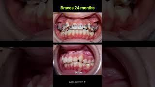 24 months Braces Transformation ‼️ #dentalcare #satisfying #dentist #dentalhealth #shorts