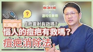 惱人的痘疤消除法！痘疤有救嗎？痘疤雷射有效嗎？feat.優勢游可任醫師【REME】