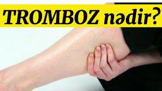 TROMBOZ nədir? SəBəBLəR və simptomları,müalicasi..