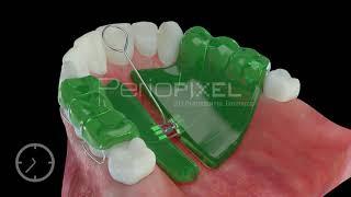 Vídeo 3D Expansor dental - Tráiler