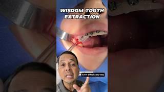 Extracting Wisdom Tooth WITH Braces | In Office to Hands On Dental Training #shorts