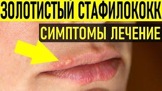 Золотистый стафилококк. Симптомы золотистого стафилококка