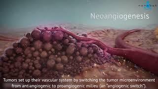 Tumor growth - 3D medical animation