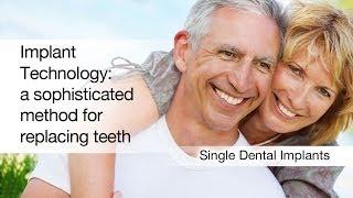 Single Dental Implants Charlotte NC