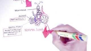 Emphysema - Introduction, Types, Symptoms, Diagnosis