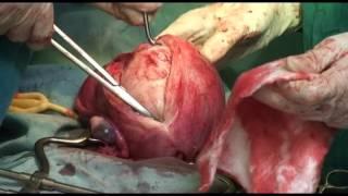 Myomectomy - remove and innoculate the myoma