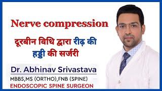 Endoscopic Spine Surgery Interlaminar For Nerve Compression | Nerve Pressure | Dr Abhinav Srivastava