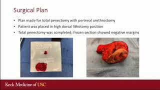 Core Videos (2020): Loop Perineal Urethrostomy Following Total Penectomy