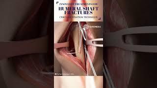 Innovative Treatment for Humerus Fracture #medical #shorts #tech #suture #science #animation #learn