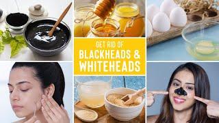 Easy Ways To Remove Blackheads And Whiteheads At Home