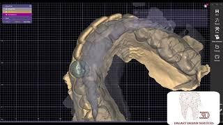 Exocad Tutorial : Eggshell Restorations using Exocad