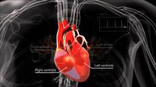 What is atrial fibrillation?