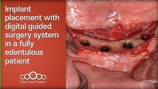 Implant placement with digital guided surgery system in a fully edentulous patient-[Dr. Kim Yongjin]