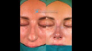 Nose Tip Surgery | Closed Rhinoplasty