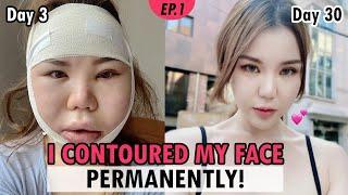 [SUB] Zygoma & Jawline Reduction in Korea | vline facial bone surgery vlog review | Recovery Results