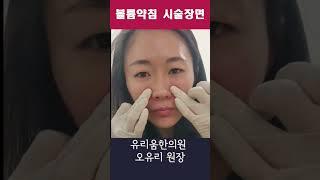 볼륨약침(한방 필러) 제 얼굴에 직접 해봤어요:)                  #shorts #한방성형 #잠실실리프팅 #필러후기