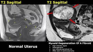 Uterus MRI Normal Vs Abnormal Images | Uterine & Cervix Pathologies | Cancer Staging | Gynecology