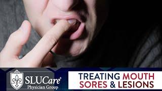 Mouth Sores & Lesions: Diagnosing and Treatment - SLUCare Otolaryngology