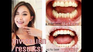 My Invisalign Experience｜隐适美隐形牙套的经验分享