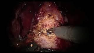 Robotic Assisted Laparoscopic Radical Prostatectomy | Brigham and Women's Hospital