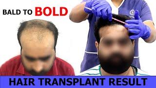 Baldness Grade (NW-6) | 4500+ Grafts Hair Transplant Result | HairFree HairGrow Clinic India