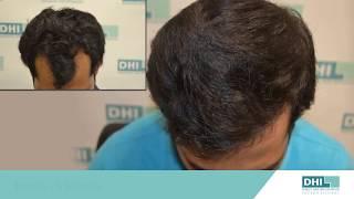 Amazing before & after hair transplant results- Amazing Hair Transformation- Hair Transplant Results