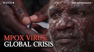 Mpox Outbreak: Understanding the global health emergency