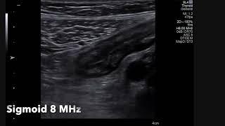 Tracing the colon and terminal ileum on intestinal ultrasound for the beginners