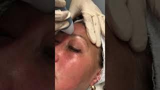 EXION RF MICRONEEDLING