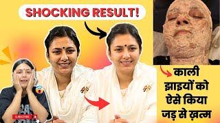 Jhaiyo ka 100% Permanent ilaaj | Pigmentation, Melasma Remedy | Skin Whitening Home Remedies