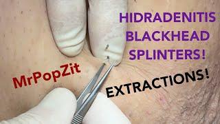 Have you ever seen Splinter Blackheads extracted before!? Check it out! Oxidized plug removal.