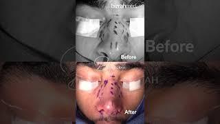 Nose Job Before And After Result : Dr. Bashar Bizrah/ London/Dubai