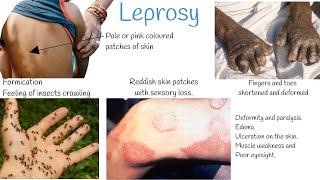 Leprosy signs and symptoms, Treatment.  (Hansen's Disease)