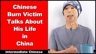 Chinese Burn Victim Talks About His Life in China - Intermediate Chinese - Chinese Conversation