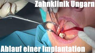 Zahnbehandlung in Ungarn: Ablauf einer Implantation in der Zahnklinik bis zum Implantatkörper Doku