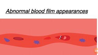 Abnormal blood film appearances